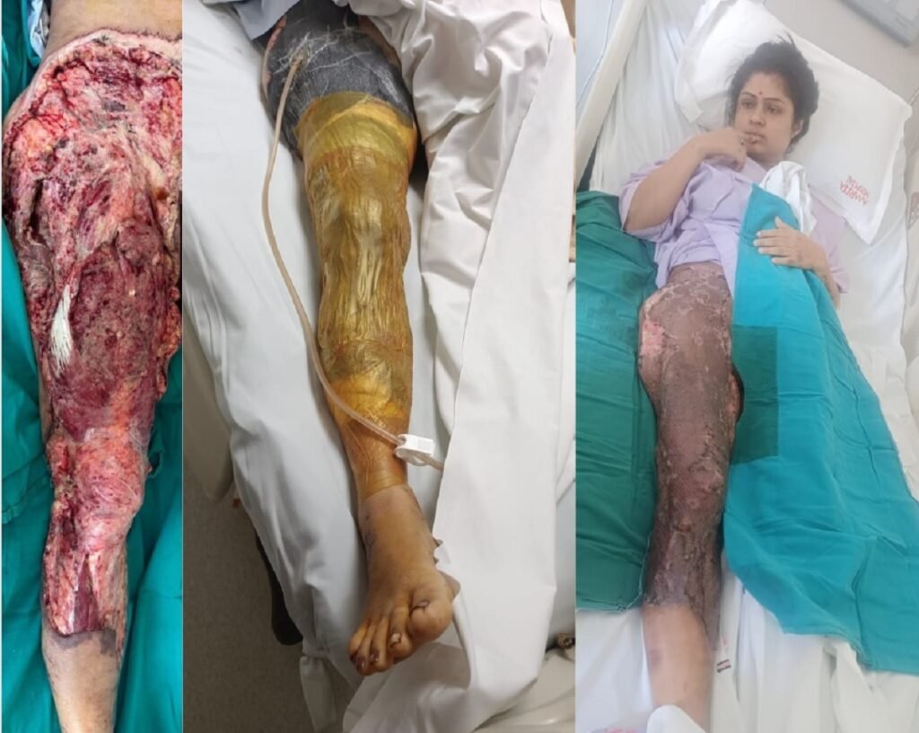 ত্রকনা চেন্দুনা পুরুরবা, সর্জরী ১৯না কল্লকখ্রবা: অমৃতা হোস্পিতালদা পিঙ্কুগী অঙকপনা থল্লবা রিকোভরী